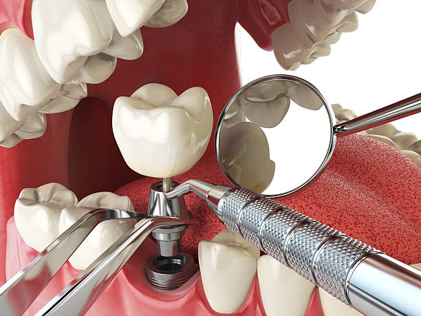 Best Knocked-Out Tooth (Avulsed Tooth) Treatment in Edgewood, NM